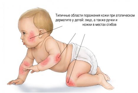 Атопический дерматит у детей: симптомы, методы лечения и спасительная профилактика